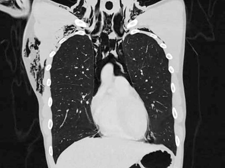 CT chest frontal mediastinal