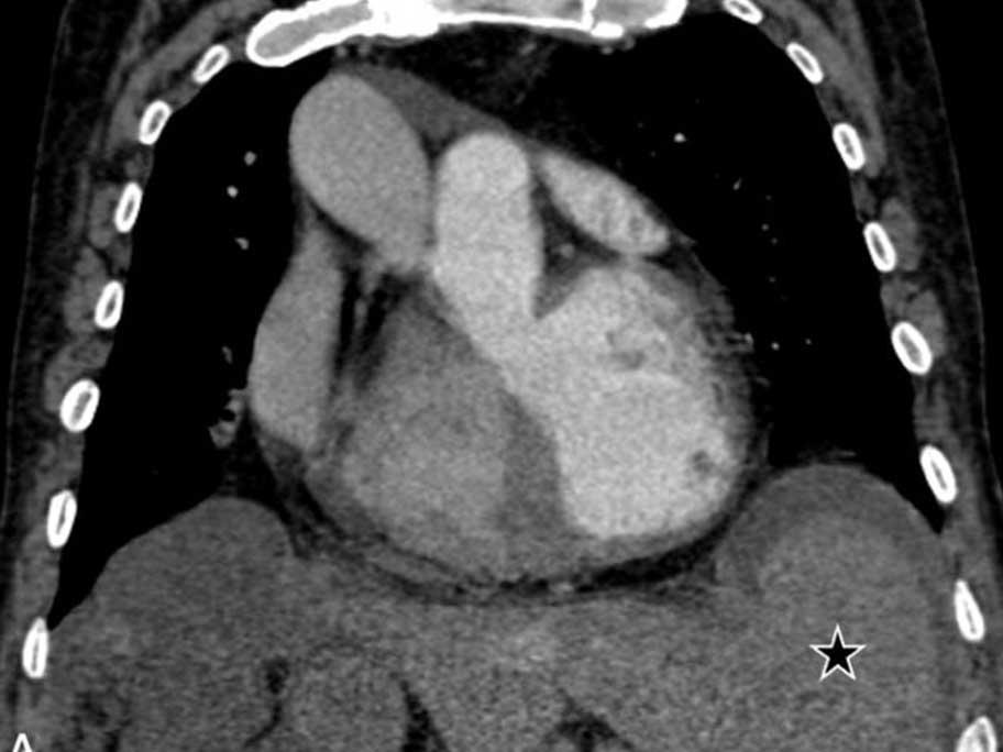 CT scan