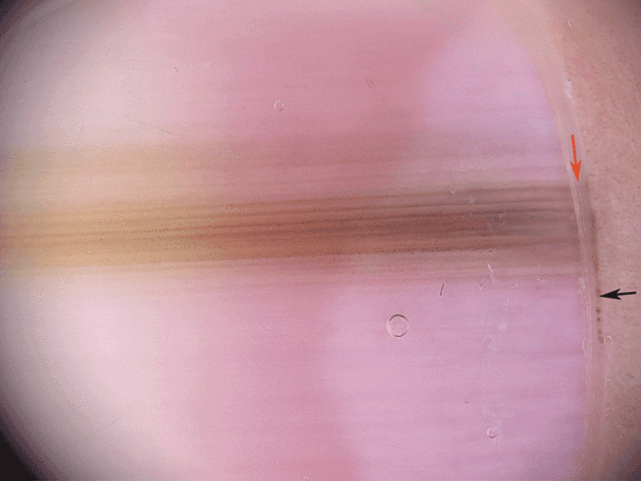 nail pigment pattern